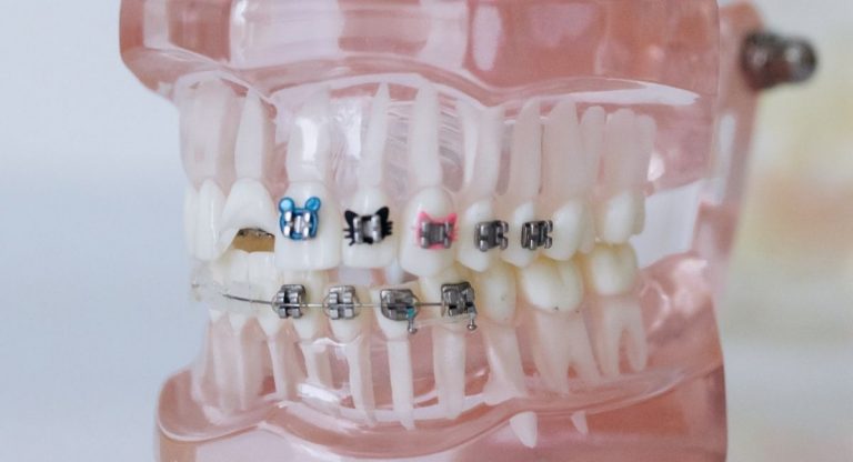 17 Fun Facts About Orthodontics & Braces